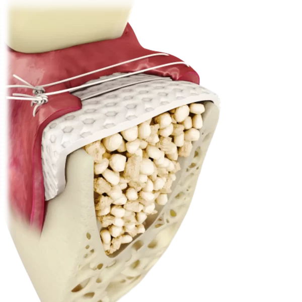 Cytoplast™ TXT-200 - Imagen 3