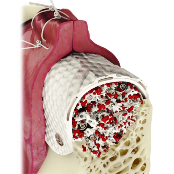 Cytoplast™ Ti-250 - Imagen 2